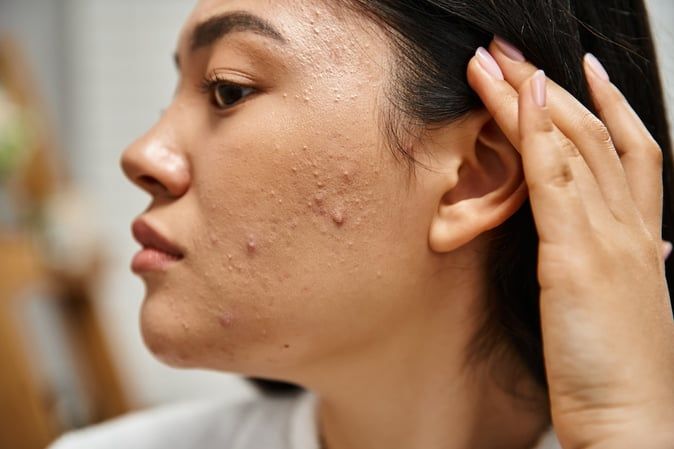 ACNE TYPES EXPLAINED: WHAT YOU’RE DEALING WITH AND HOW TO HANDLE IT
