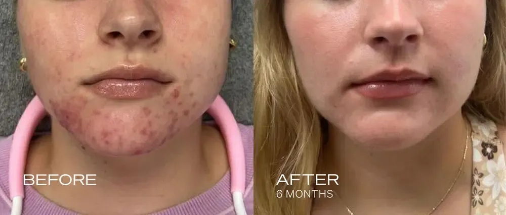 Before and after comparison of a woman's chin and lower face showing acne improvement.