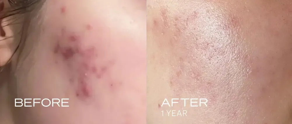 Before and after comparison of skin with acne healing and clearing up.