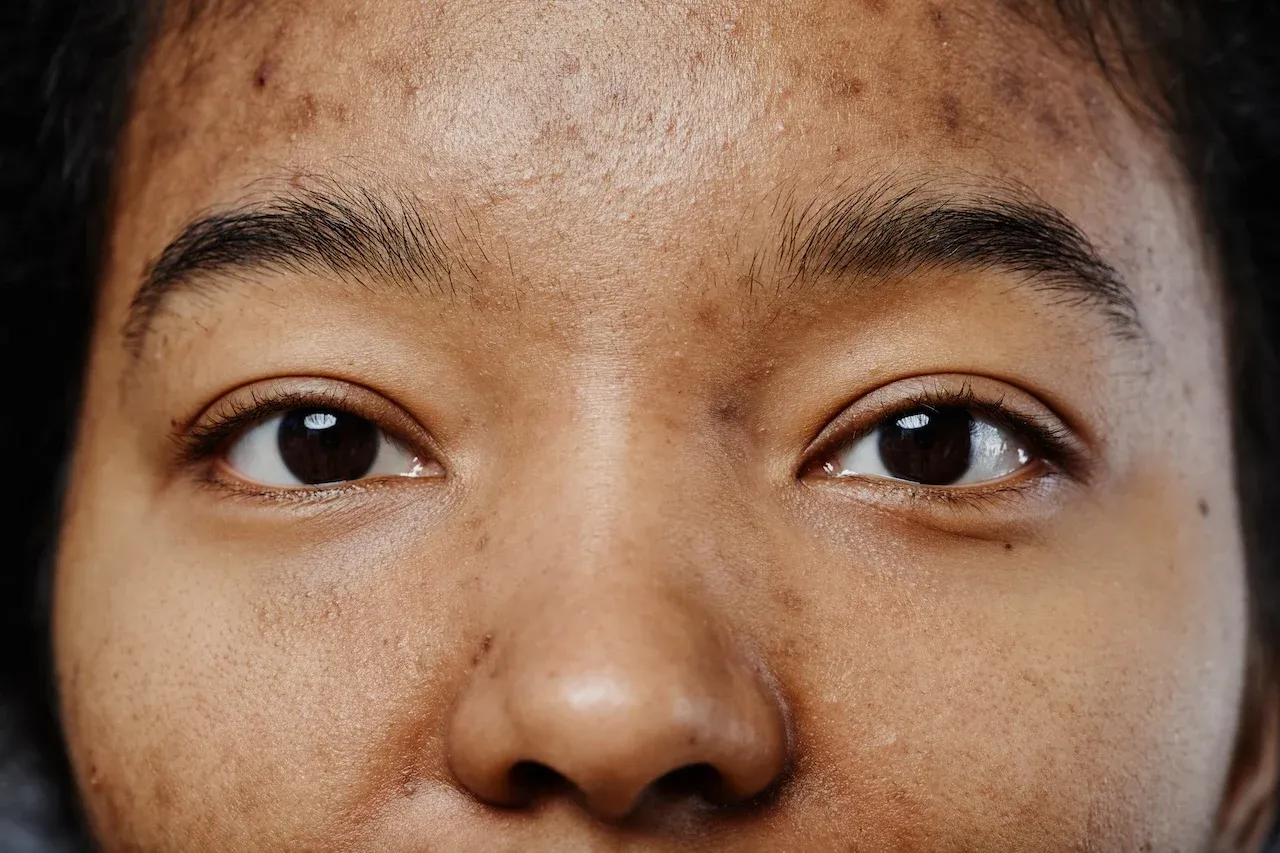 PREVENT POST-ACNE DARK SPOTS WITH THESE TIPS